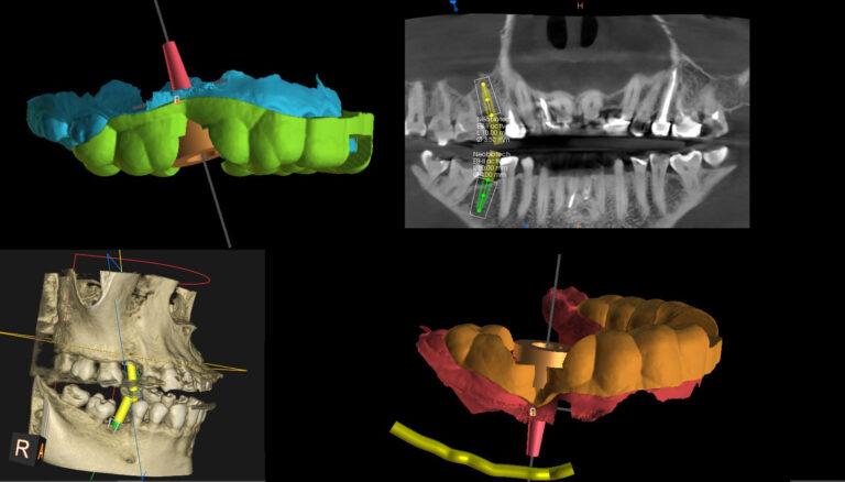 implantacja nawigowana